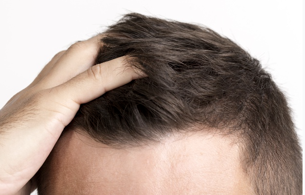 El Minoxidil: el tratamiento que te podrá ayudar evitar la caída del pelo | Canariasenred Noticias de Canarias