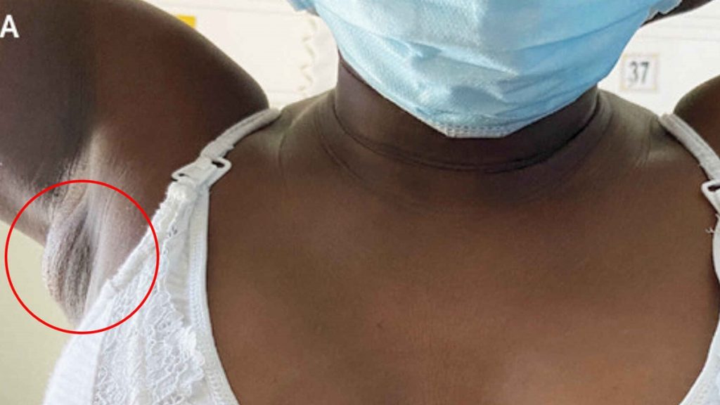 La masa de tejido mamario detectada en la axila de la paciente. I N Engl J Med