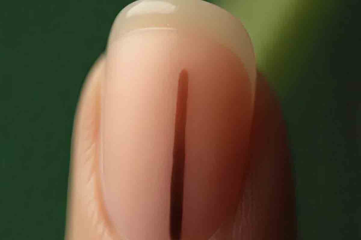 Melanoma salud