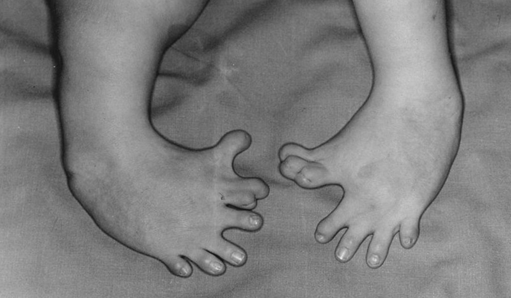 Malformación de un bebé en los pies debido al fármaco talidomida suministrado a embarazadas entre los años 1957 y 1963. DA
