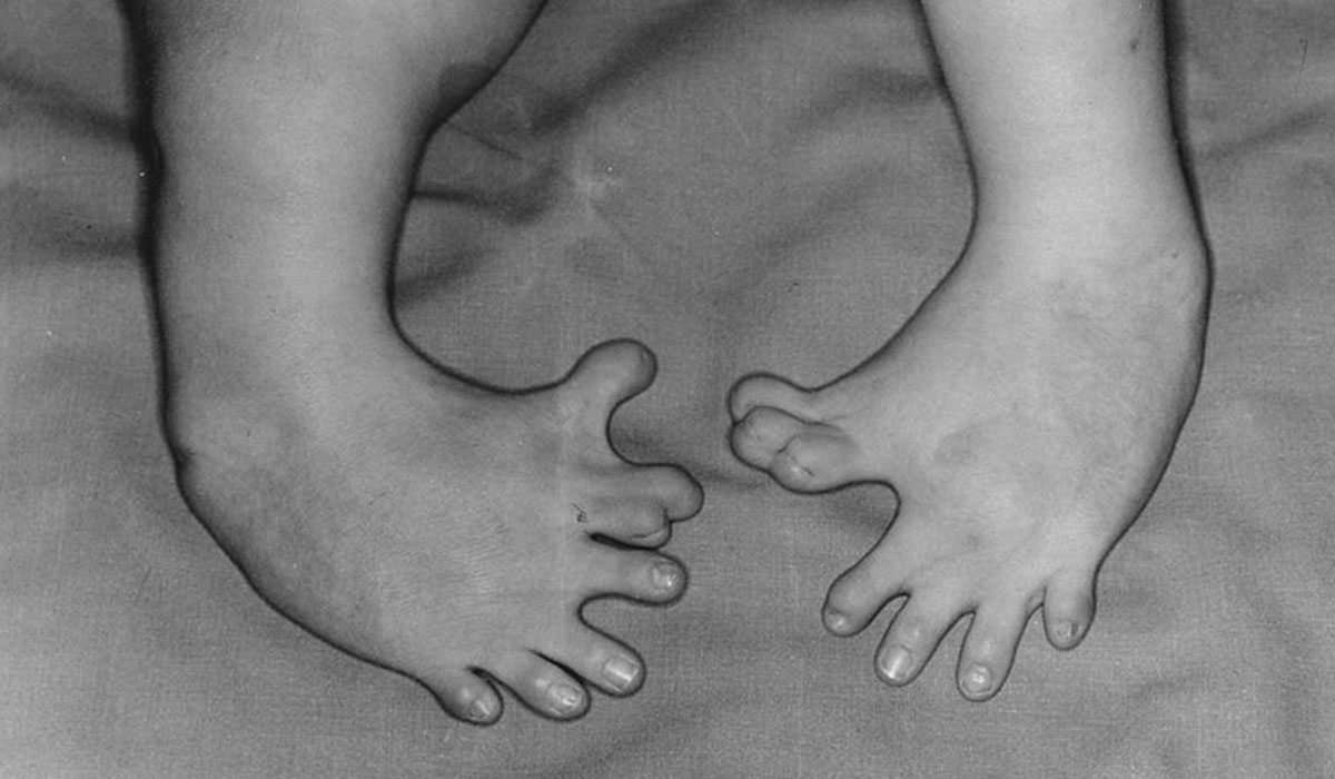 Malformación de un bebé en los pies debido al fármaco talidomida suministrado a embarazadas entre los años 1957 y 1963. DA