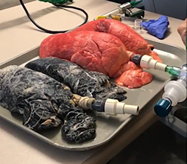 Pulmón sano junto a un pulmón con cáncer. / DAILY MAIL
