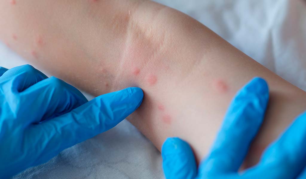 Un joven portugués desarrolla un hasta ahora desconocido efecto secundario por viruela del mono
