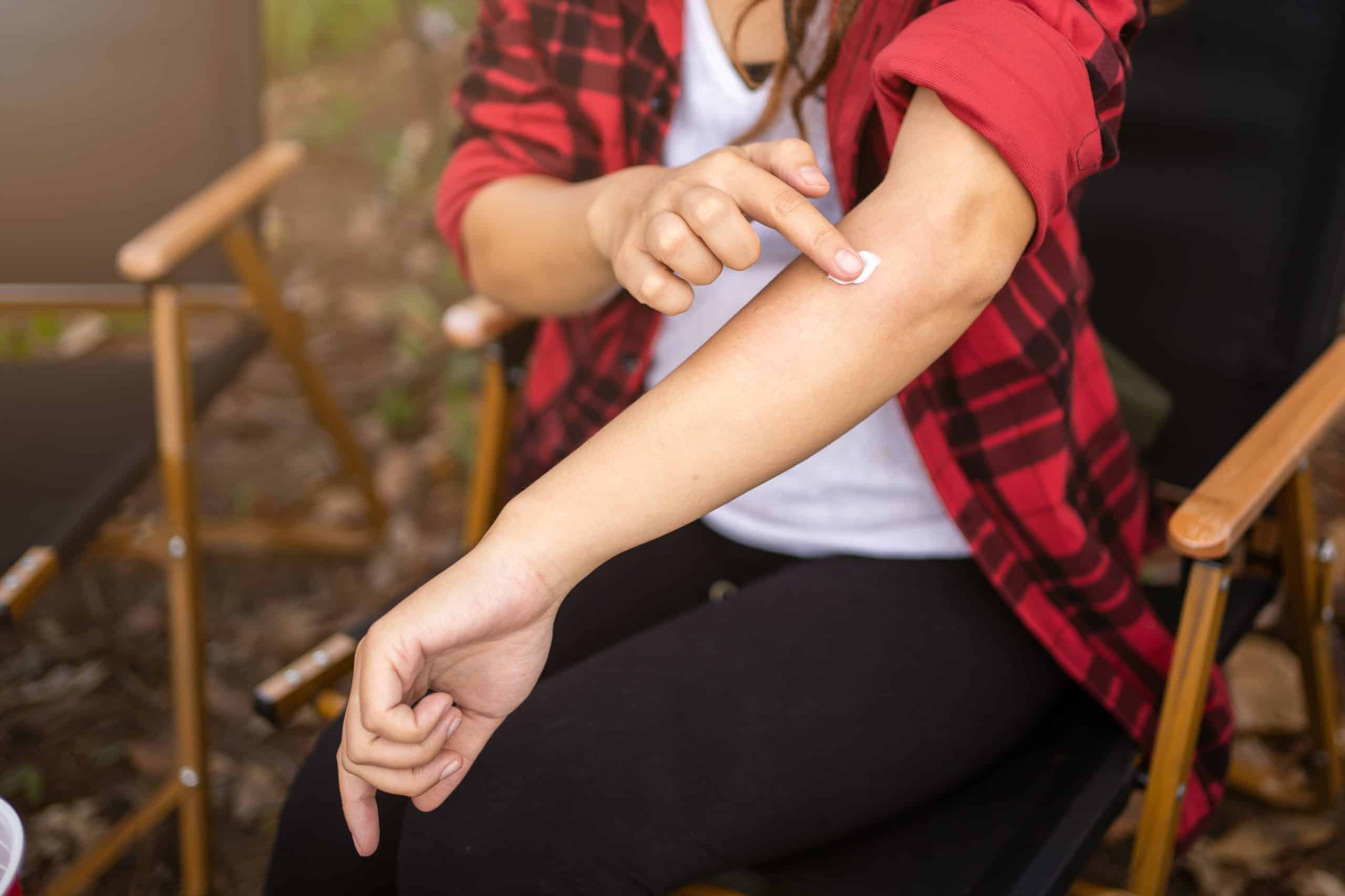 Mosquitos en verano: por esto te pican y así puedes evitarlo según un conocido tiktoker